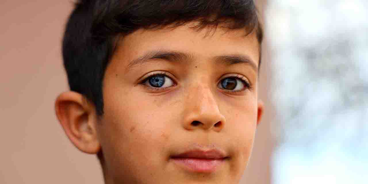 Görenler hayret ediyor: Gözünün yarısı mavi yarısı kahverengi