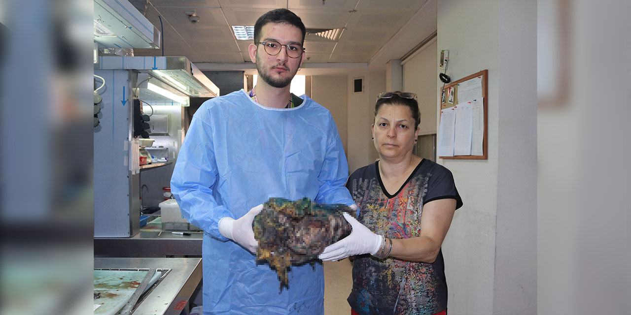 Ağrı şikayeti ile gelen hastanın karnında 10 kiloluk tümör bulundu