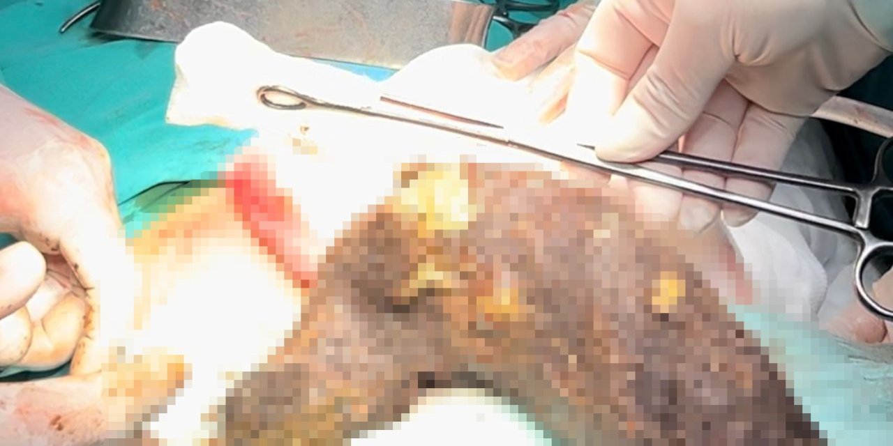Genç kızın midesinden 2 kilogram kıl yumağı çıkartıldı!