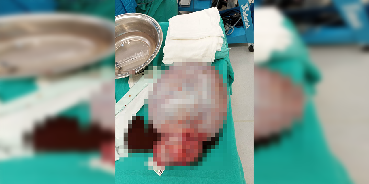 Hasta kadının karnından 6 kg ağırlığında kitle çıktı