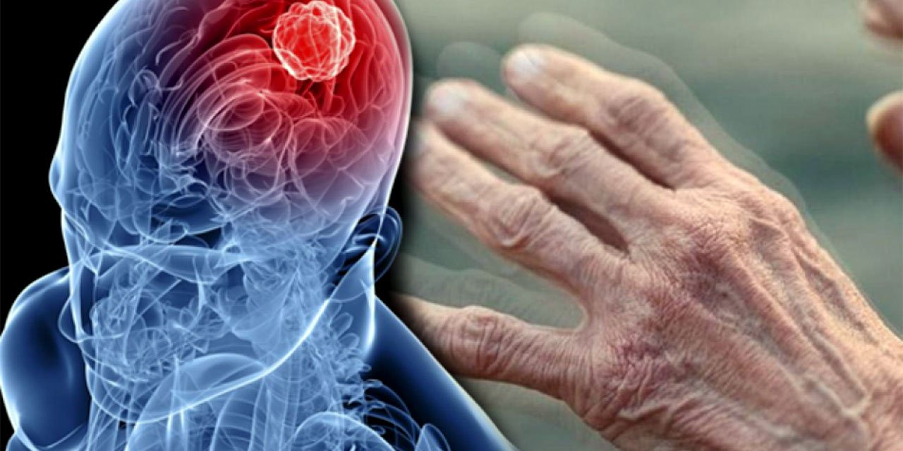 Parkinson erken teşhisle kontrol altına alınabilir