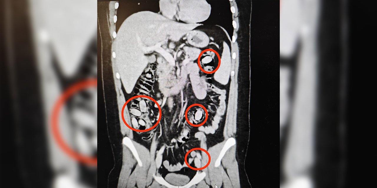 Eskişehir'e 44 kapsül uyuşturucu midesine sokan şahıs yakalandı